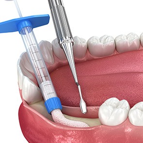 a 3D illustration showing a dental ridge expansion