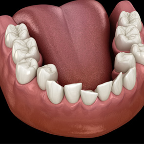 Illustration of crowded teeth