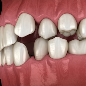 Illustration of spaced out teeth