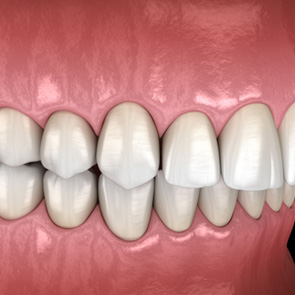 Illustration of an overbite