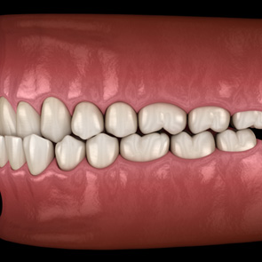 Illustration of an underbite