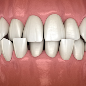 Illustration of a crossbite