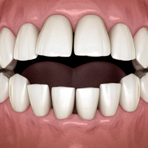 Illustration of an open bite