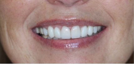 Close up of bright teeth after cosmetic dentistry in Tulsa