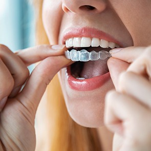 A young woman holding her Invisalign tray over her teeth