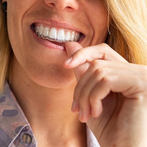 A woman putting her Invisalign aligner on her teeth