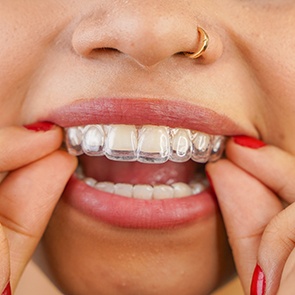 Woman putting in clear aligners