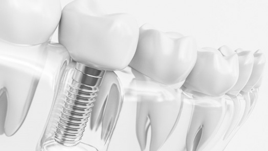 : a 3D illustration of a dental implant