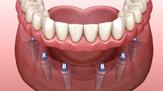  Digital illustration of dental implants