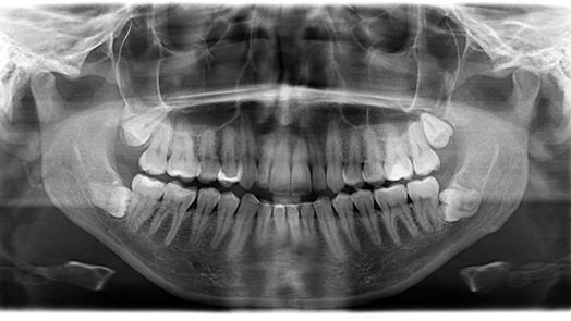 Dental X-ray showing four wisdom teeth